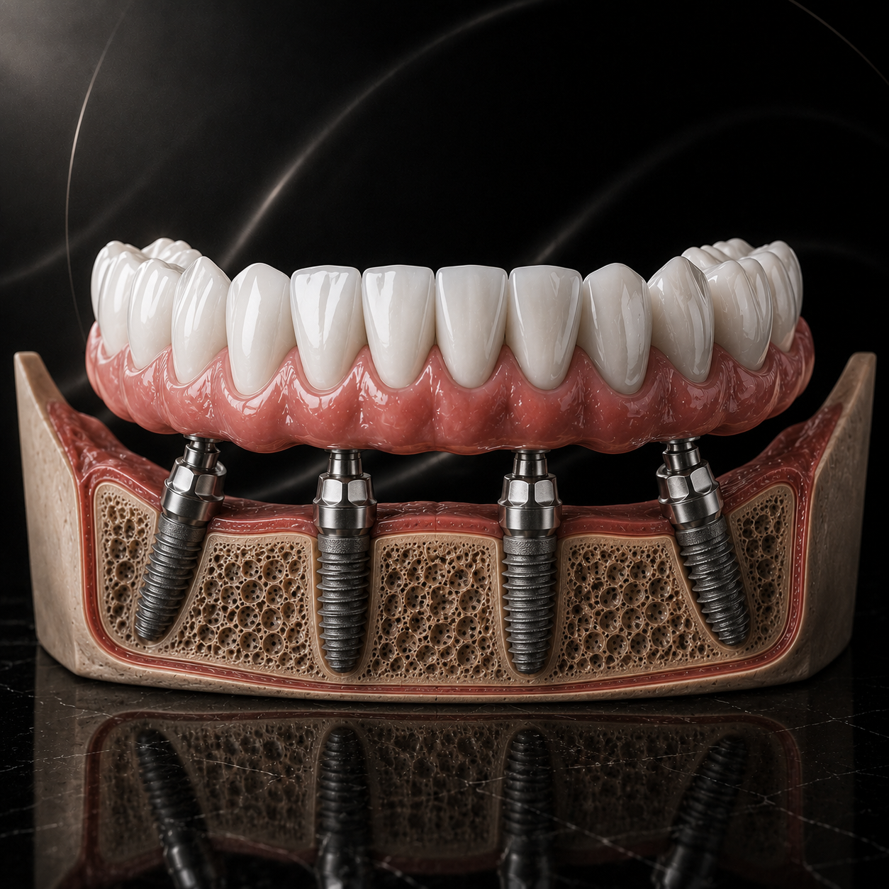 all on 4 implants